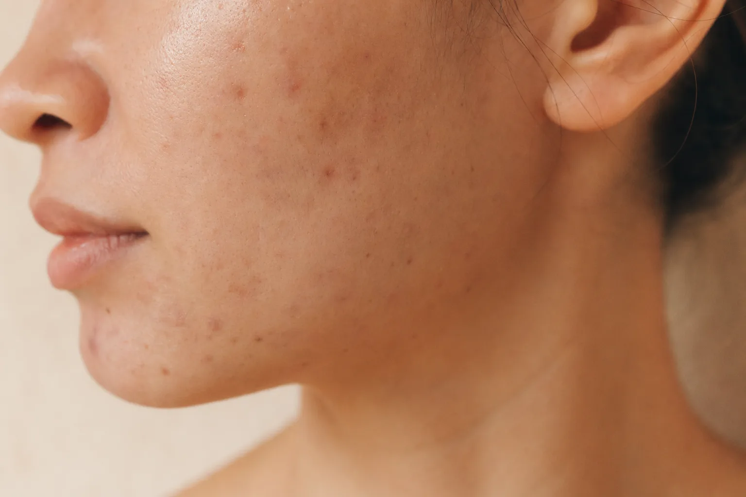 Acne-traject